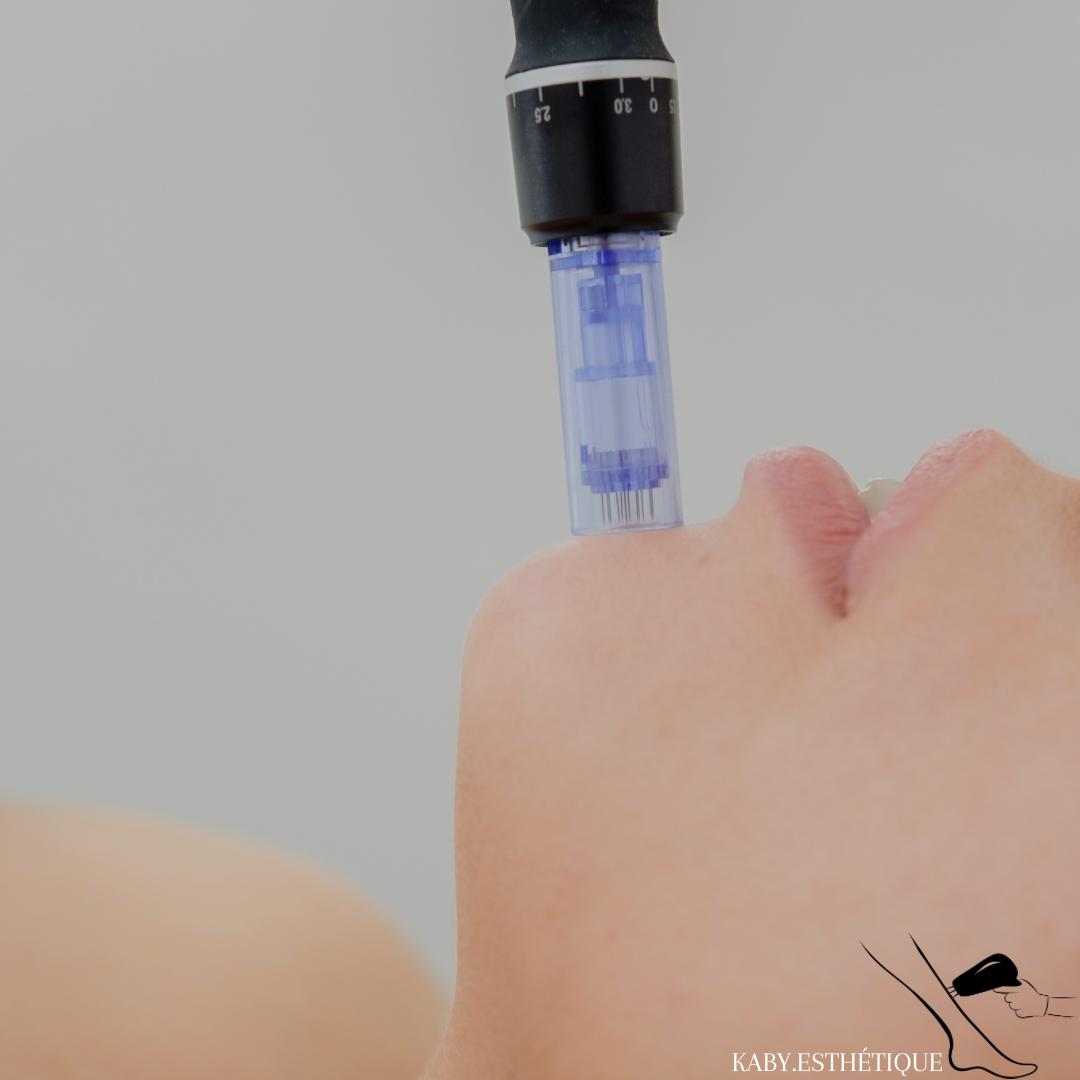Microneedling